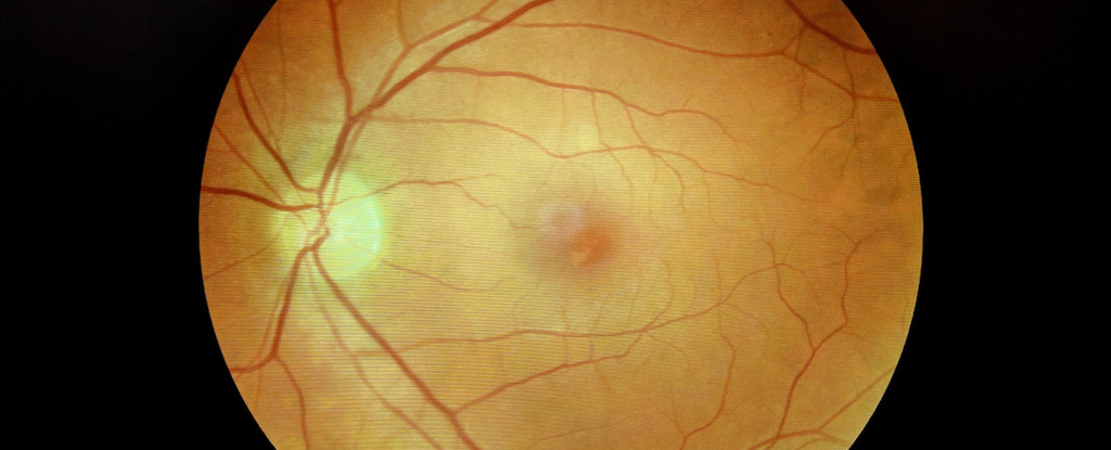 Covid puede causar placas de Alzheimer en los ojos y el cerebro: Sciencealert