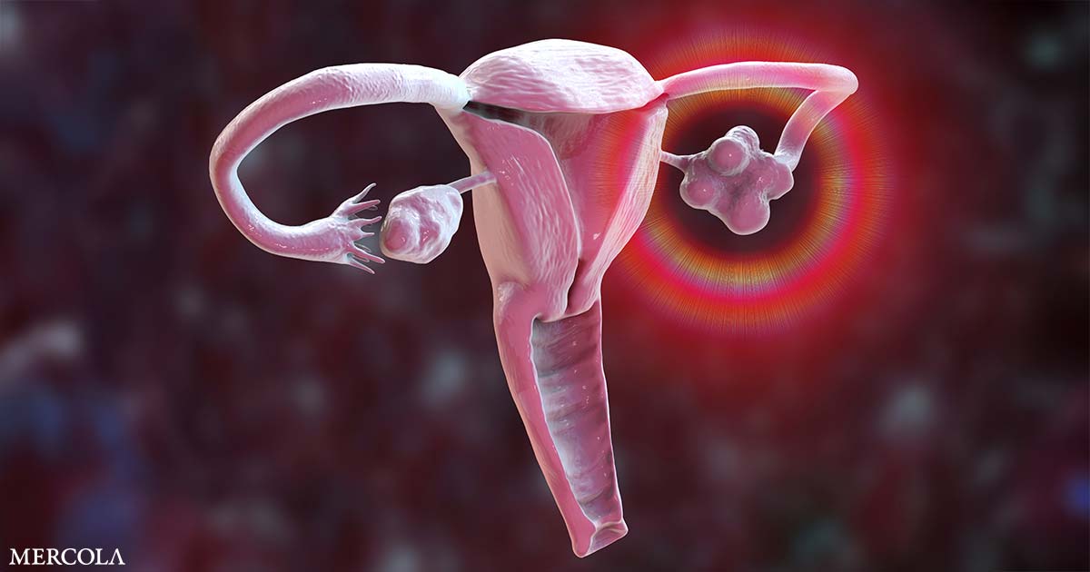 Qué hacer si te diagnostican un quiste ovárico