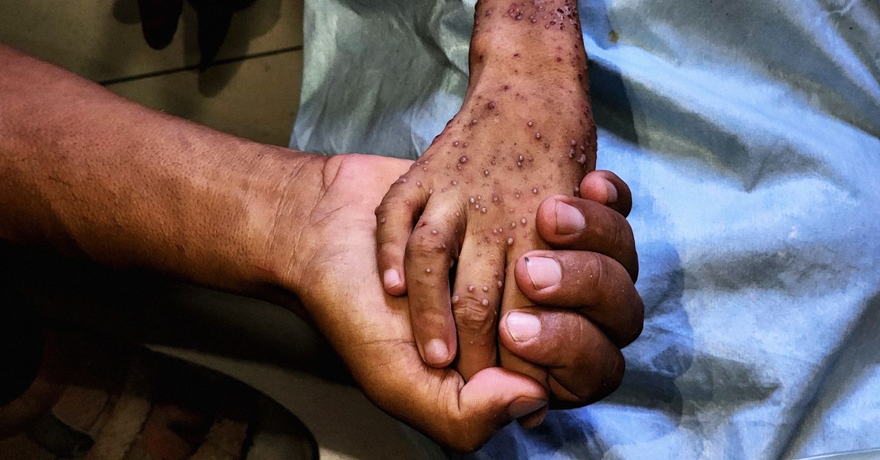 Los graves efectos a largo plazo de la crisis de desnutrición de Gaza