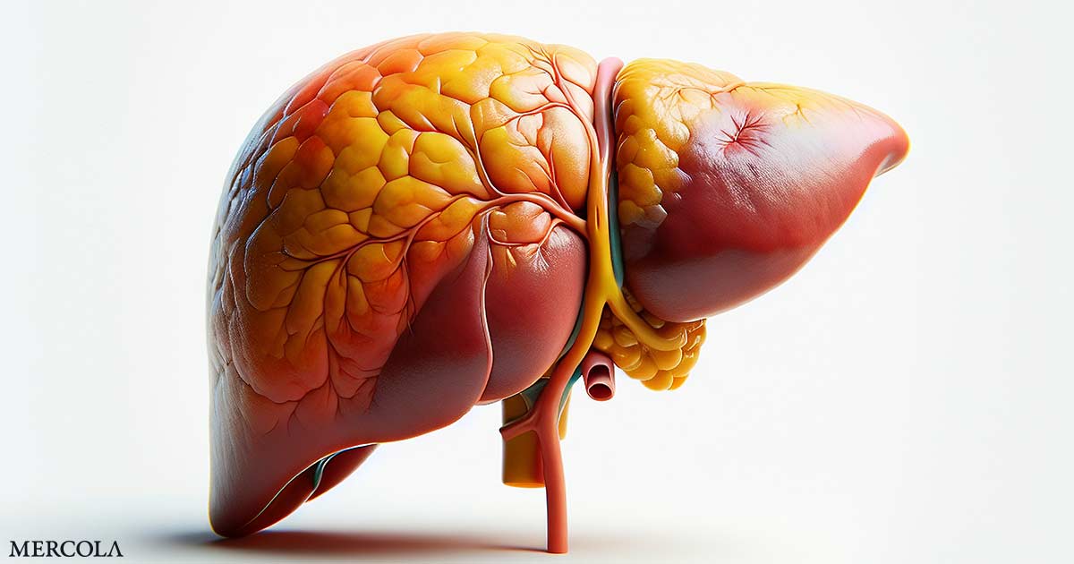 La enfermedad del hígado graso es común en personas con diabetes tipo 2 y a menudo se pierde
