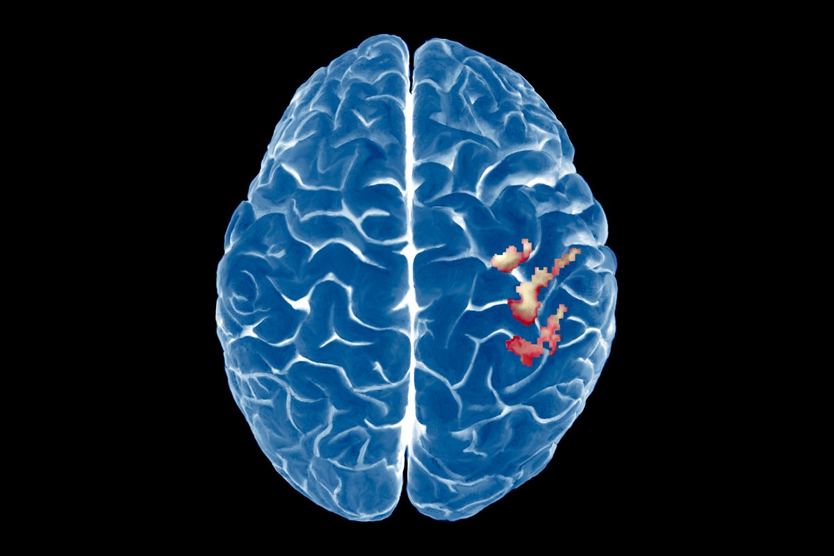El mapa del cerebro del cuerpo es sorprendentemente estable, incluso después de que se pierde una extremidad