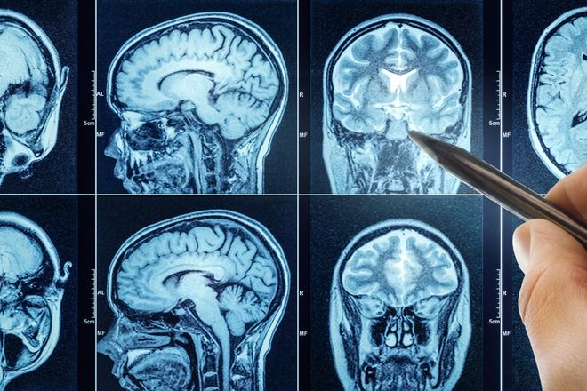 Una resonancia magnética cerebral podría predecir qué tan rápido está envejeciendo su cuerpo