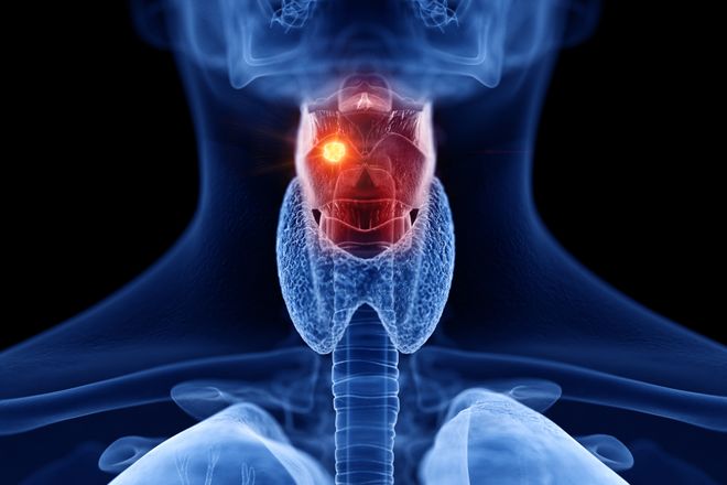La IA pronto puede detectar el cáncer de laríngula solo escuchando su voz