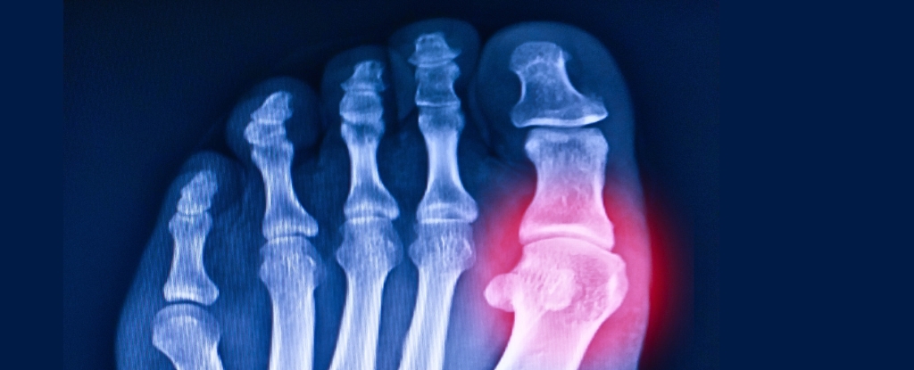 Los científicos reviven Gene de 20 millones de años para ayudar a luchar contra la gota: Sciencealert